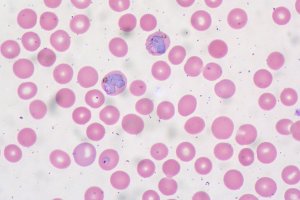 By Ed Uthman from Houston, TX, USA - Malaria in Peripheral BloodUploaded by CFCF, CC BY 2.0, https://commons.wikimedia.org/w/index.php?curid=30104644