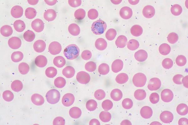 By Ed Uthman from Houston, TX, USA - Malaria in Peripheral BloodUploaded by CFCF, CC BY 2.0, https://commons.wikimedia.org/w/index.php?curid=30104644