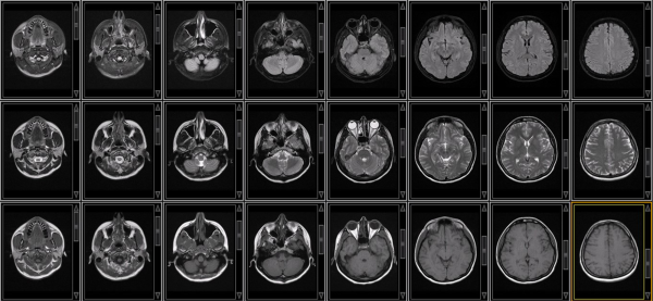 mri